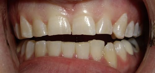 Before crowns and bonding